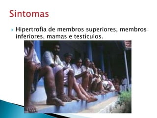 Hipertrofia de membros superiores, membros
inferiores, mamas e testículos.
 
