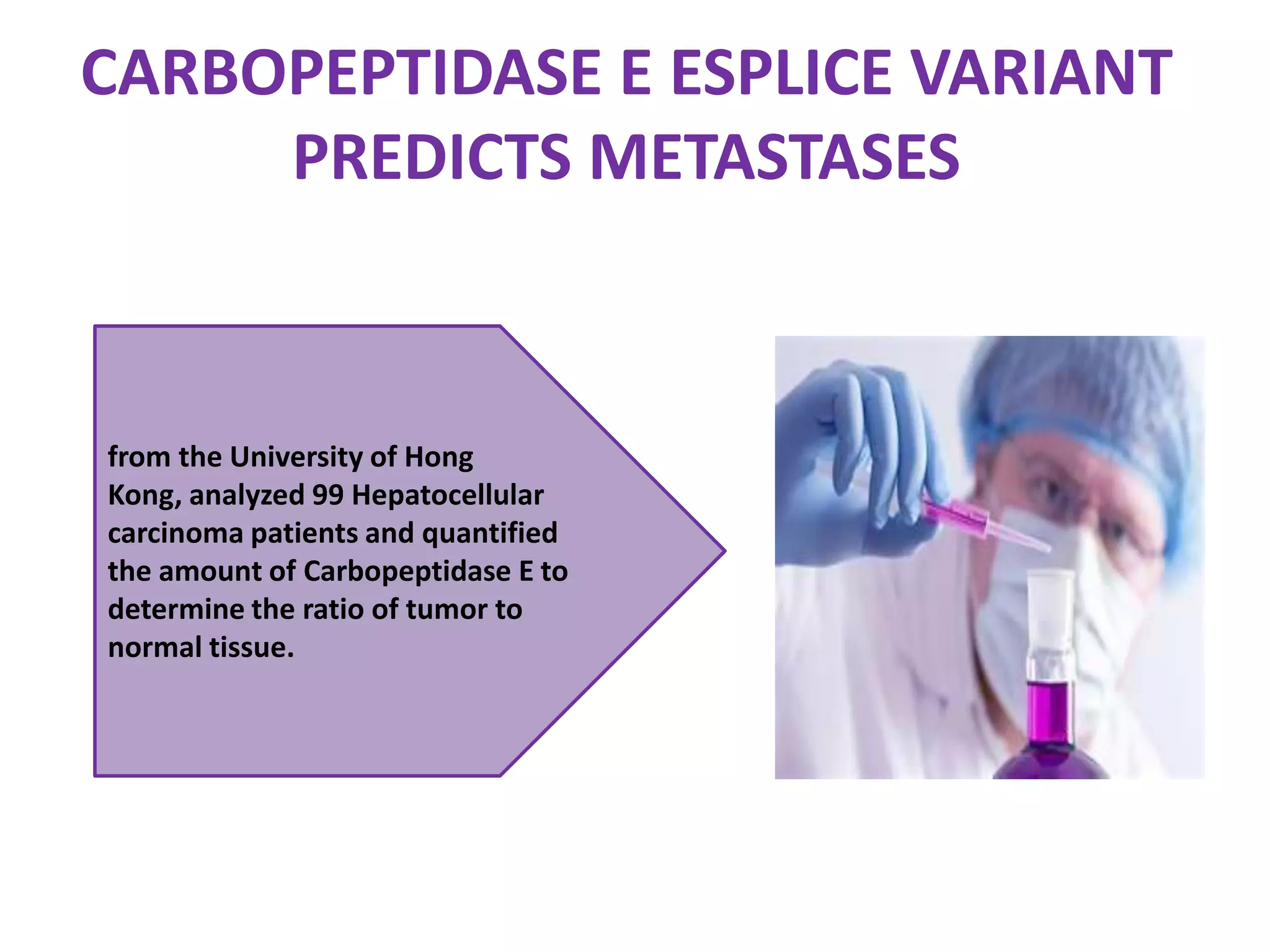 CARBOPEPTIDASE E ESPLICE VARIANT PREDICTS METASTASESfrom the University of Hong Kong, analyzed 99 Hepatocellular carcinoma patients and quantified the amount of Carbopeptidase E to determine the ratio of tumor to normal tissue. 