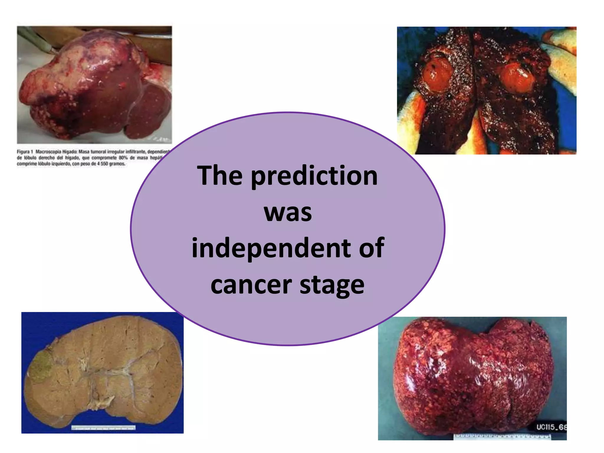 The prediction was independent of cancer stage