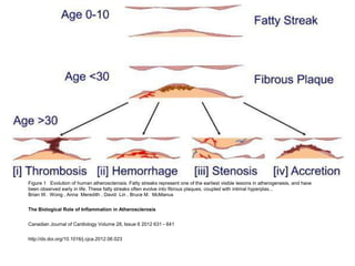 Figure 1 Evolution of human atherosclerosis. Fatty streaks represent one of the earliest visible lesions in atherogenesis, and have
been observed early in life. These fatty streaks often evolve into fibrous plaques, coupled with intimal hyperplas...
Brian W. Wong , Anna Meredith , David Lin , Bruce M. McManus


The Biological Role of Inflammation in Atherosclerosis


Canadian Journal of Cardiology Volume 28, Issue 6 2012 631 - 641


http://dx.doi.org/10.1016/j.cjca.2012.06.023
 