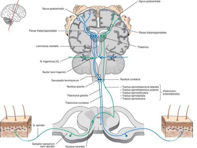 hemiparesis