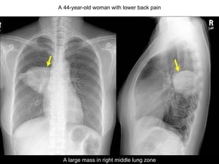 20475212 A 44-year-old woman with lower back pain A large mass in right middle lung zone 