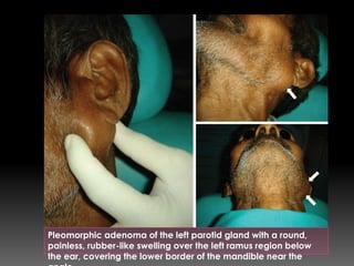 Pleomorphic adenoma of the left parotid gland with a round,
painless, rubber-like swelling over the left ramus region below
the ear, covering the lower border of the mandible near the
 