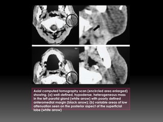 Axial computed tomography scan (encircled area enlarged)
showing, (a) well-defined, hypodense, heterogeneous mass
in the left parotid gland (white arrow) with poorly defined
anteromedial margin (black arrow); (b) variable areas of low
attenuation seen on the posterior aspect of the superficial
lobe (white arrow)
 