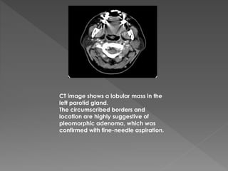 CT image shows a lobular mass in the
left parotid gland.
The circumscribed borders and
location are highly suggestive of
pleomorphic adenoma, which was
confirmed with fine-needle aspiration.
 