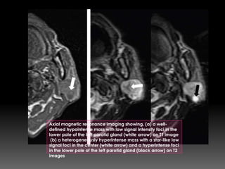 Axial magnetic resonance imaging showing, (a) a well-
defined hypointense mass with low signal intensity foci in the
lower pole of the left parotid gland (white arrow) on T1 image
(b) a heterogeneously hyperintense mass with a star-like low
signal foci in the center (white arrow) and a hyperintense foci
in the lower pole of the left parotid gland (black arrow) on T2
images
 