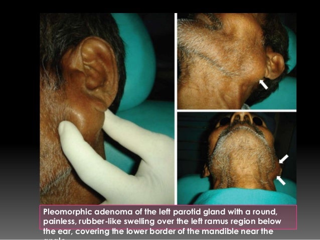 pleomorphic adenoma