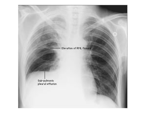 Diagnostic Imaging of Pleural Lesions | PPT