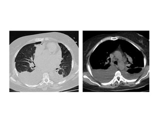 Diagnostic Imaging of Pleural Lesions | PPT