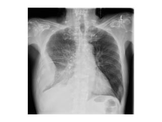 Diagnostic Imaging of Pleural Lesions | PPT