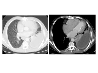 Diagnostic Imaging of Pleural Lesions | PPT
