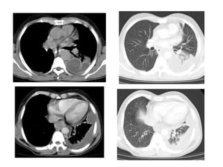 Diagnostic Imaging of Pleural Lesions | PPT