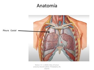 Anatomía
Pleura Costal
Netter, F. H. 1. (2019). Atlas of human
anatomy. Seventh edition. Philadelphia, PA,
Elsevier.
 