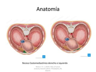 Anatomía
Receso Costomediastínico derecho e izquierdo
Netter, F. H. 1. (2019). Atlas of human
anatomy. Seventh edition. Philadelphia, PA,
Elsevier.
 