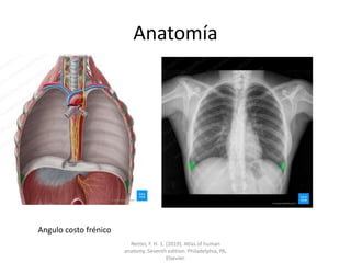 Anatomía
Angulo costo frénico
Netter, F. H. 1. (2019). Atlas of human
anatomy. Seventh edition. Philadelphia, PA,
Elsevier.
 