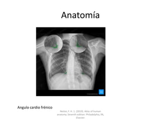 Anatomía
Angulo cardio frénico
Netter, F. H. 1. (2019). Atlas of human
anatomy. Seventh edition. Philadelphia, PA,
Elsevier.
 