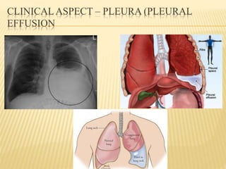 CLINICALASPECT – PLEURA (PLEURAL
EFFUSION
 