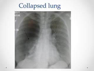 Collapsed lung
 
