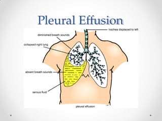 Pleural Effusion
 