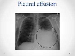 Pleural effusion
 