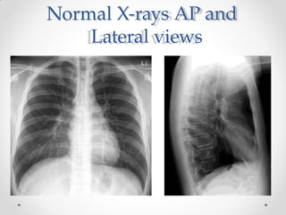 Normal X-rays AP and
Lateral views
 