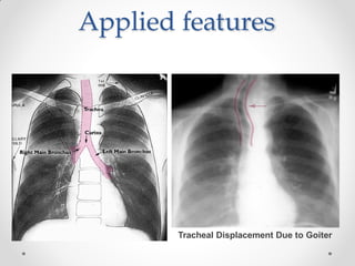 Applied features
Tracheal Displacement Due to Goiter
 