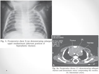 Pleurae,  Trachea & Principal Bronchi By Dr Rabia Inam Gandapore.pptx