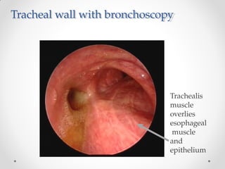 Tracheal wall with bronchoscopy
Trachealis
muscle
overlies
esophageal
muscle
and
epithelium
 