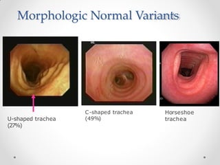 Morphologic Normal Variants
U-shaped trachea
(27%)
C-shaped trachea
(49%)
Horseshoe
trachea
 