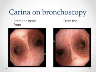 Carina on bronchoscopy
From the head From the
front
 