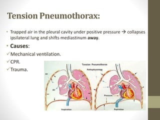 Tension Pneumothorax:
• Trapped air in the pleural cavity under positive pressure  collapses
ipsilateral lung and shifts mediastinum away.
• Causes:
Mechanical ventilation.
CPR.
Trauma.
 
