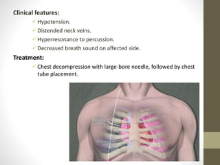 Clinical features:
Hypotension.
Distended neck veins.
Hyperresonance to percussion.
Decreased breath sound on affected side.
Treatment:
Chest decompression with large-bore needle, followed by chest
tube placement.
 