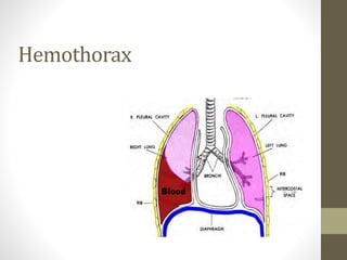 Hemothorax
 