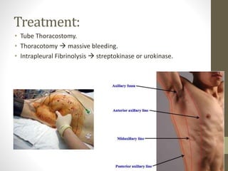 Treatment:
• Tube Thoracostomy.
• Thoracotomy  massive bleeding.
• Intrapleural Fibrinolysis  streptokinase or urokinase.
 