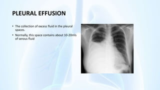 PLEURAL EFFUSION
• The collection of excess fluid in the pleural
spaces.
• Normally, this space contains about 10-20mls
of serous fluid
 