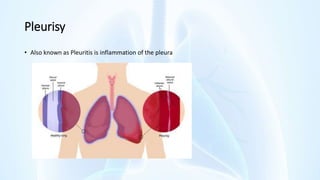 Pleurisy
• Also known as Pleuritis is inflammation of the pleura
 