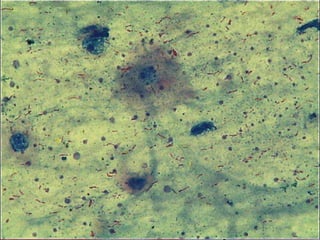 • Microbiology :
• Gram stain
• AFB
• Culture
• ADA - >43 – may suggest TB
• Cytology
 