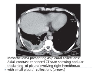 Mesothelioma presenting as pleural collections:
Axial contrast-enhanced CT scan showing nodular
thickening of pleura involving right hemithorax
with small pleural collections (arrows)
 