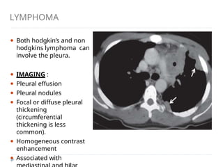LYMPHOMA
⚫ Both hodgkin’s and non
hodgkins lymphoma can
involve the pleura.
⚫ IMAGING :
⚫ Pleural effusion
⚫ Pleural nodules
⚫ Focal or diffuse pleural
thickening
(circumferential
thickening is less
common).
⚫ Homogeneous contrast
enhancement
⚫ Associated with
 