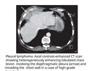 Pleural lymphoma: Axial contrast-enhanced CT scan
showing heterogeneously enhancing lobulated mass
lesion involving the diaphragmatic pleura (arrow) and
invading the chest wall in a case of high-grade
 