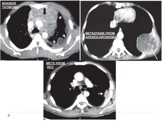 INVASIVE
THYMOMA
METASTASIS FROM
ADENOCARCINOMA
METS FROM
RCC
 