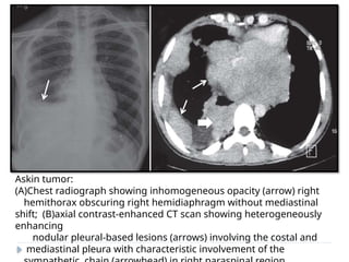 Askin tumor:
(A)Chest radiograph showing inhomogeneous opacity (arrow) right
hemithorax obscuring right hemidiaphragm without mediastinal
shift; (B)axial contrast-enhanced CT scan showing heterogeneously
enhancing
nodular pleural-based lesions (arrows) involving the costal and
mediastinal pleura with characteristic involvement of the
 