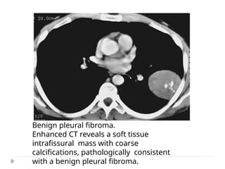 Benign pleural fibroma.
Enhanced CT reveals a soft tissue
intrafissural mass with coarse
calcifications, pathologically consistent
with a benign pleural fibroma.
 