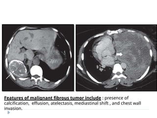 Features of malignant fibrous tumor include : presence of
calcification, effusion, atelectasis, mediastinal shift , and chest wall
invasion.
 