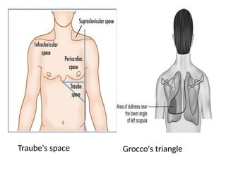 Pleural Effusion in respiratory examination-WPS Office.pptx