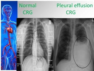 Normal
CRG

Pleural effusion
CRG

 