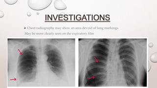  Chest radiography may show an area devoid of lung markings.
May be more clearly seen on the expiratory film
 