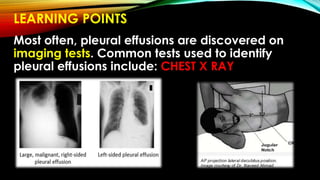 LEARNING POINTS
Most often, pleural effusions are discovered on
imaging tests. Common tests used to identify
pleural effusions include: CHEST X RAY
 