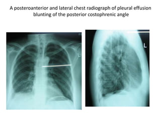 A posteroanterior and lateral chest radiograph of pleural effusion
blunting of the posterior costophrenic angle
 