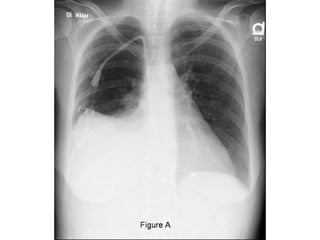RADIOGRAPHIC EXAMINATION
• 75 mL-subpulmonic space without spill over, can
obliterate the posterior costophrenic sulcus,
•...